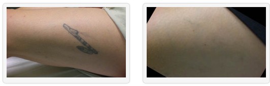 Laser Tattoo Removal UK - Unwanted Tattoos