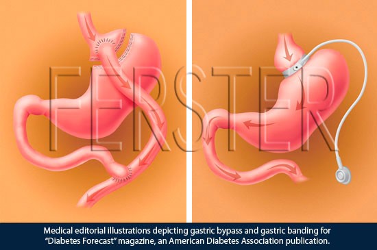 Gastric Bypasses