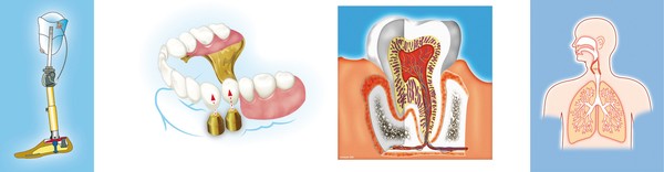 Teeth/dental implant