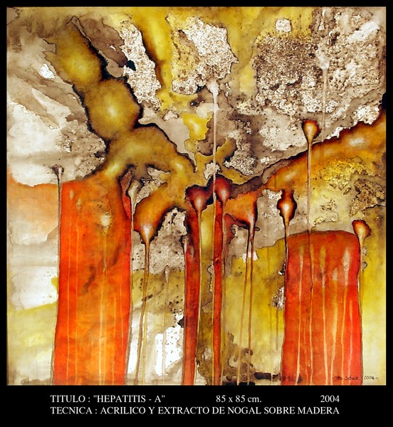 Hepatitis A