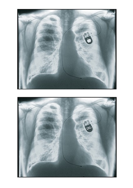 Pacemaker