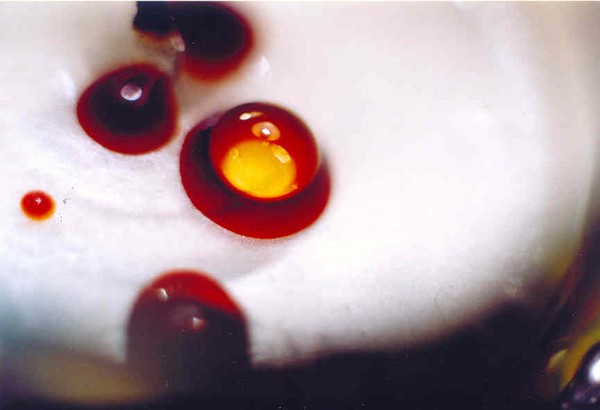 Blood with bubbles