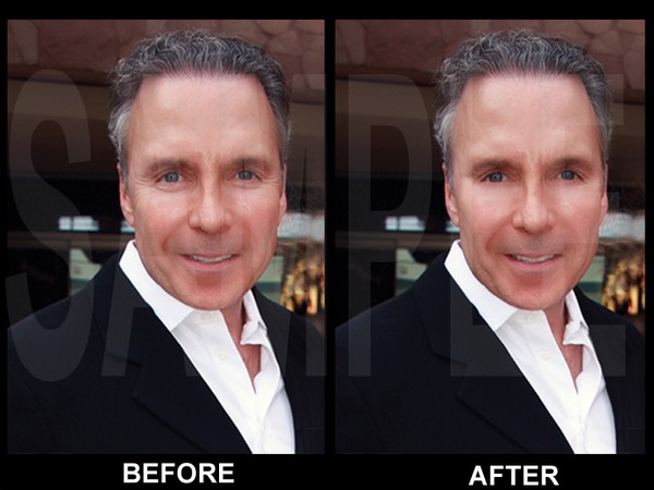 Example of Removing Wrinkles Around Eyes