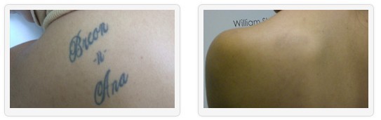 Laser Tattoo Removal - Unwanted Tattoos
