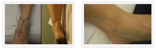 Remove Leg Tattoos - Unwanted Tattoos