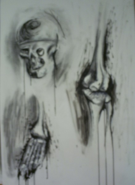 Broken bones