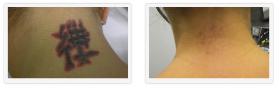 Remove Neck Tattoos - Unwanted Tattoos