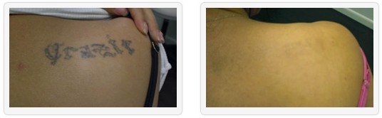 Remove Skin Tattoos - Unwanted Tattoos