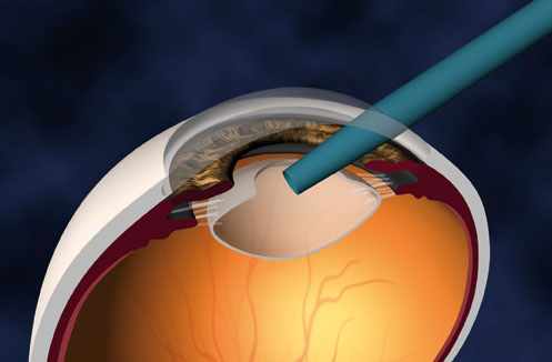 Eye
