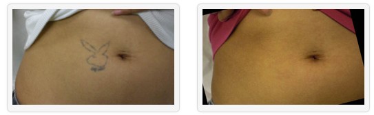 Remove Unwanted Tattoos