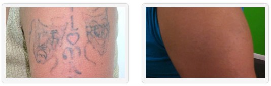 Tattoo Removal UK - Unwanted Tattoos