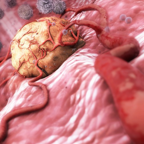 tumor, w/blood supply, and white blood cells, infl