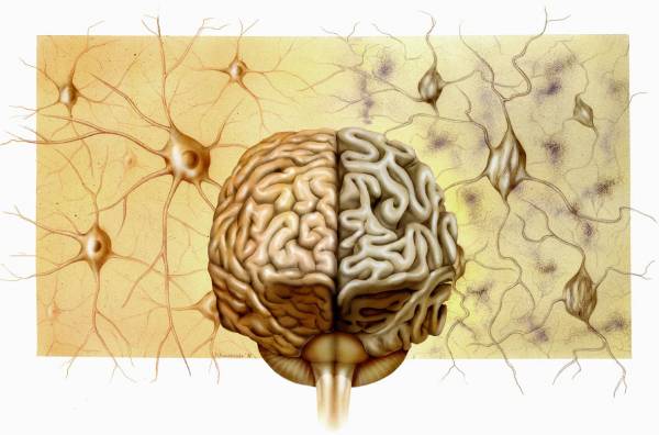 Alzheimer