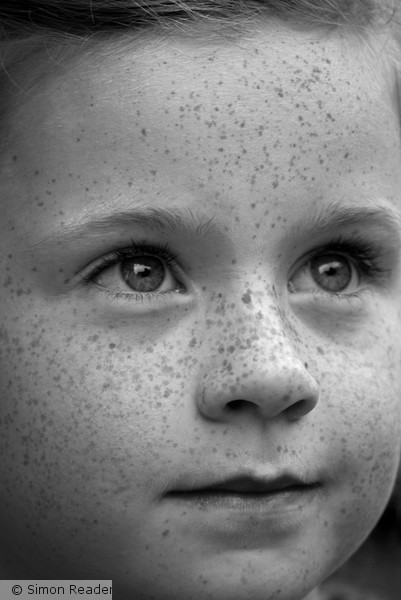 Freckle