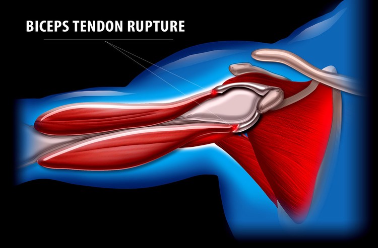 Biceps Tendon Rupture