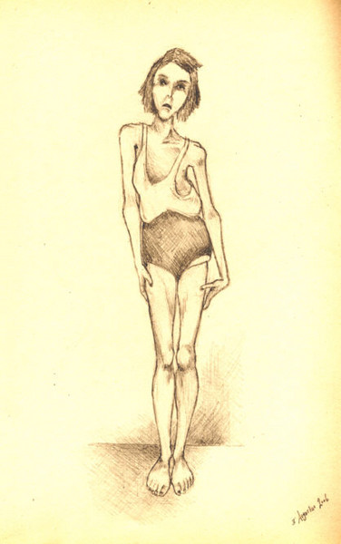 Girl with scoliosis