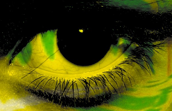 bright eye