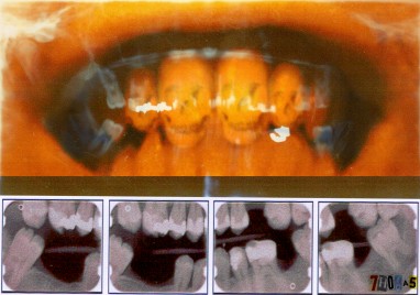 Gnashing of Teeth