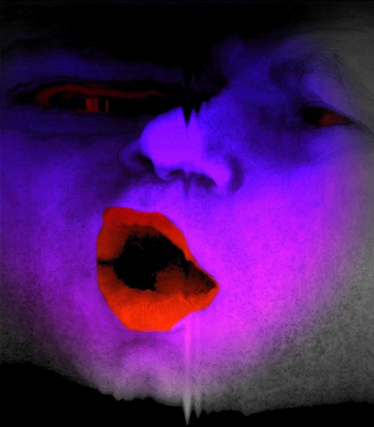 migraine