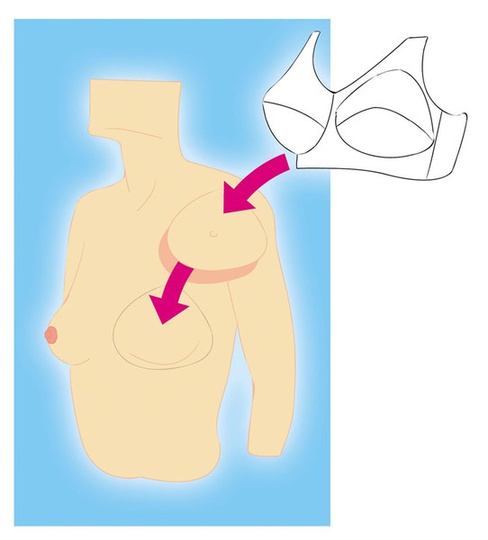 Breast prosthesis